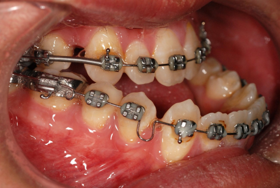 A patient with mandibular prognathism showing an overgrowth of the lower jaw.
 